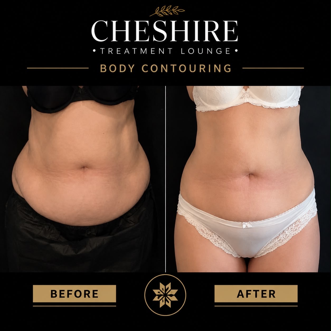 CoolSculpting after mounjaro