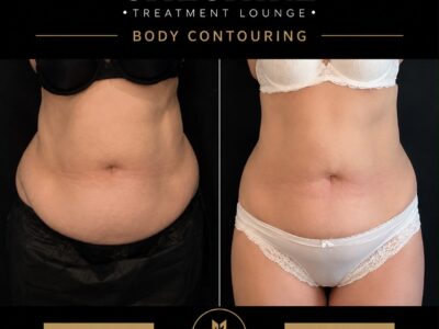 CoolSculpting after mounjaro
